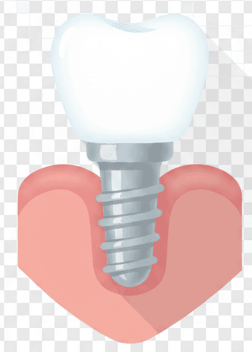Implantes Dentales