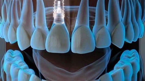 Implantes Dentales