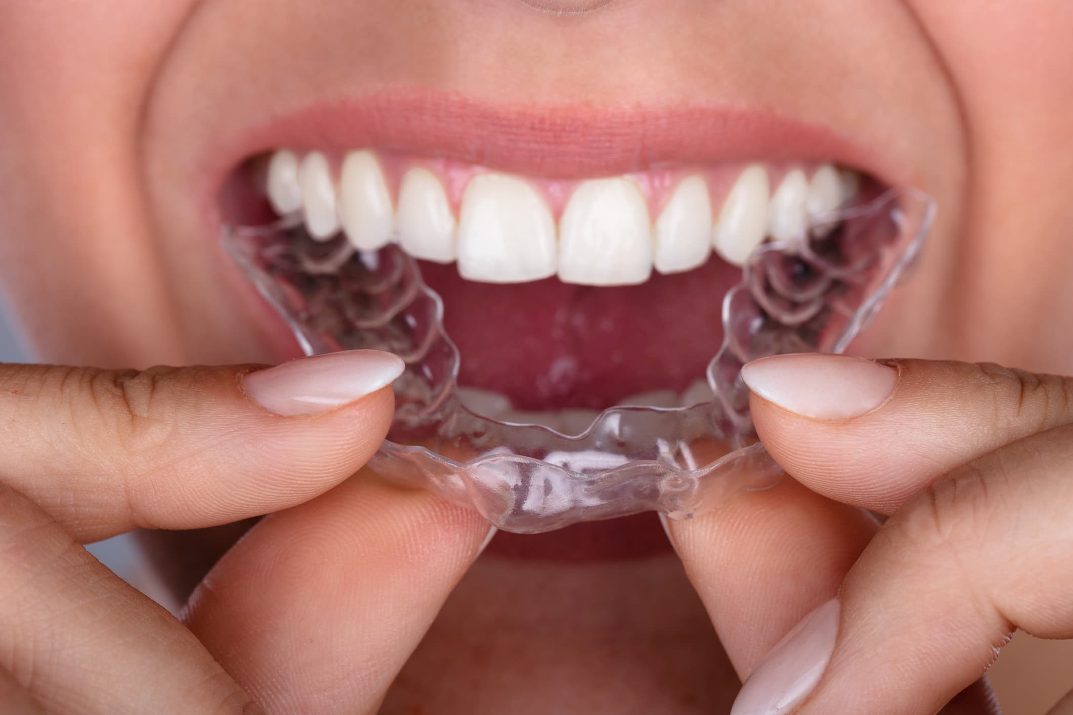 Implantes Dentales